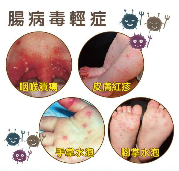 腸病毒輕症圖